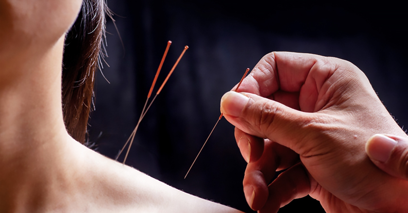 الوخز بالإبر