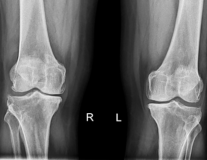 Diz Kireçlenmesi Ameliyatsız Tedaviler